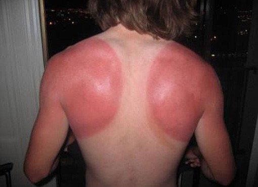home remedies sun burn